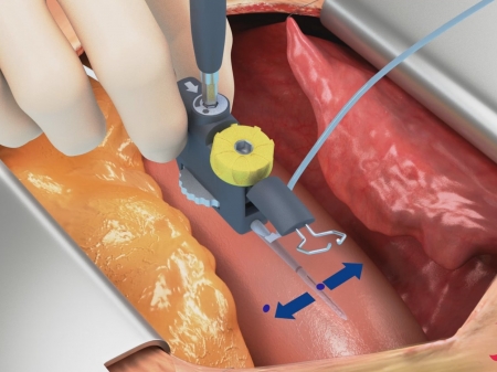 Peters Surgical Novare Enclose 3D