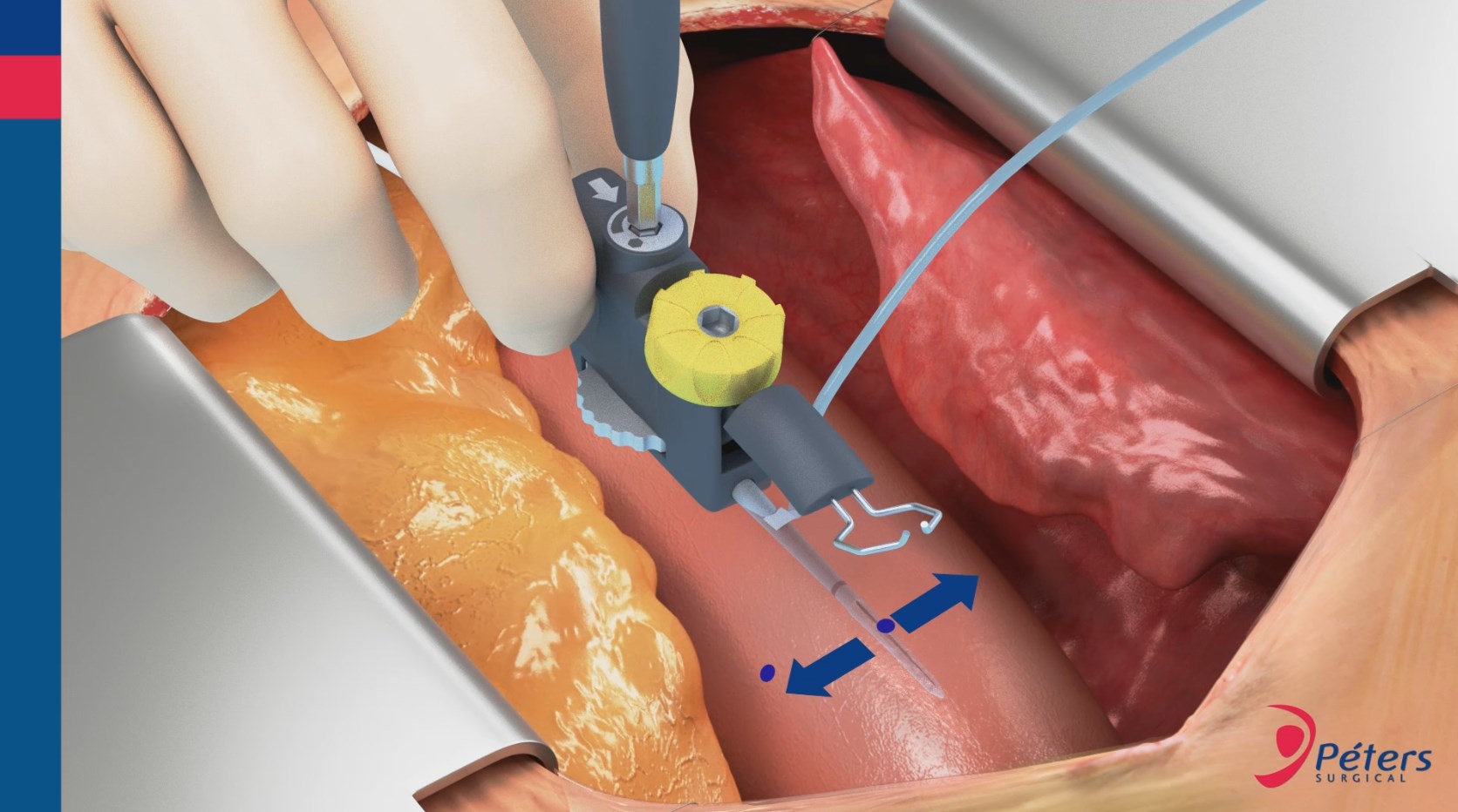 Peters Surgical Novare Enclose 3D